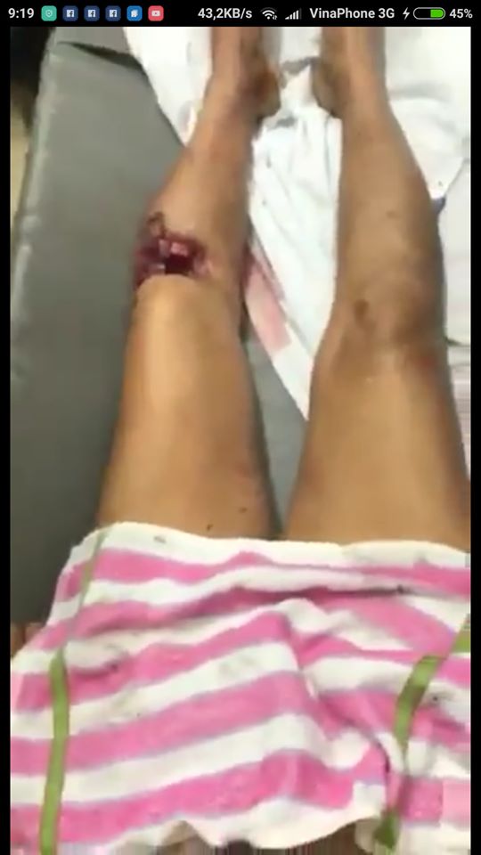 Dấu vết ở đầu gối chân trái cho thấy Cụ Lê Đình Kình bị tra tấn hoặc bị đạn bắn cộng với tra tấn. Ảnh: Internet