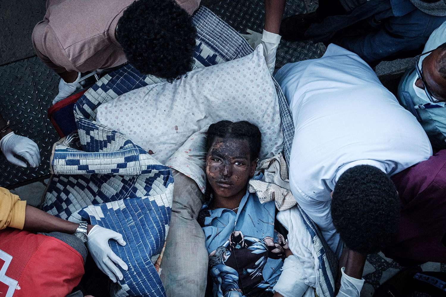 Một thường dân bị thương nặng ở Togoga được đưa đến bệnh viện ở Mekele, thủ phủ Tigray vào ngày 23/6/2021, một ngày sau khi xảy ra vụ không kích chết người nhắm vào một khu chợ nằm phía Bắc Tigray, Ethiopia. Ảnh: YASUYOSHI CHIBA/AFP VIA GETTY IMAGES