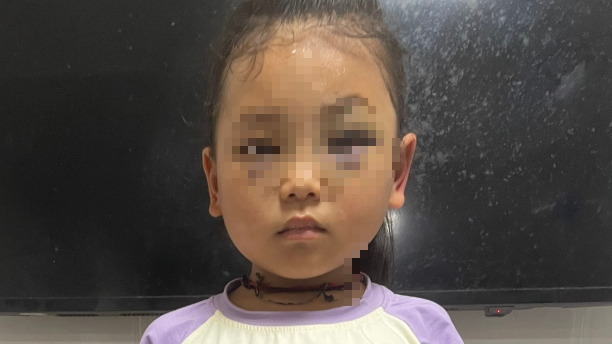 Hai mắt em bé học sinh lớp 1 bầm tím, nghi do bị cô giáo hành hung trong lớp học. Ảnh: Phòng Giáo dục - Đào tạo huyện Mù Cang Chải, tỉnh Yên Bái